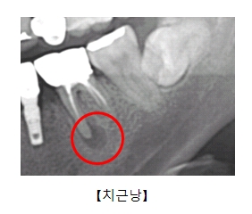 치근낭이 발생한 x-ray사진