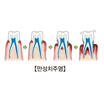 만성 취주염이 발생되며 잇몸에 미치는 과정을 예시