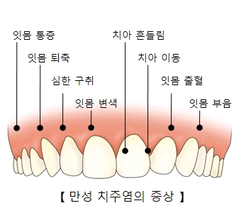 잇몸통증 잇몸퇴축 심한구취 잇몸변색 치아흔들림 치아이동 잇몸출혈 잇몸부음등 만성 치주염의 증상 예시