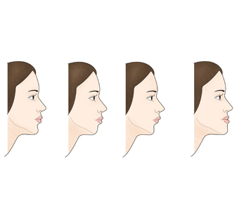 턱끝왜소증에 따른 얼굴형태의 차이의 예시