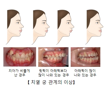 치아가 비뚫게 난 경우 윗턱이 아태럭보다 많이 나와 있는 경우 아래턱이 많이 나와 있는 경우의 치열 궁 관계의 이상 차이점 예시