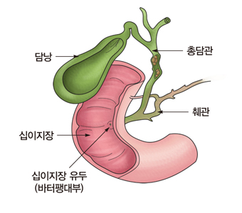 담낭 총담관 췌관 십이지장 십이지장 유투(바터팽대부)의 위치의 예시