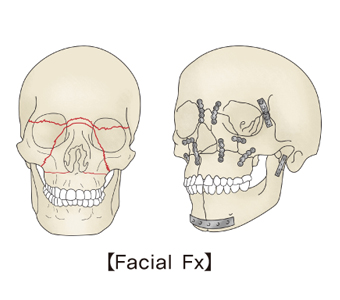 안면골절의 예시한 두개골