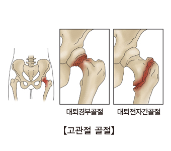 고관절골절 대퇴경부골절,대퇴전자간골절 사진예시