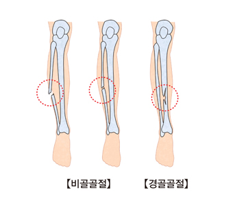 비골골절과경골골절의 사진 예시