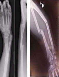 골절된 팔의 X-ray 사진