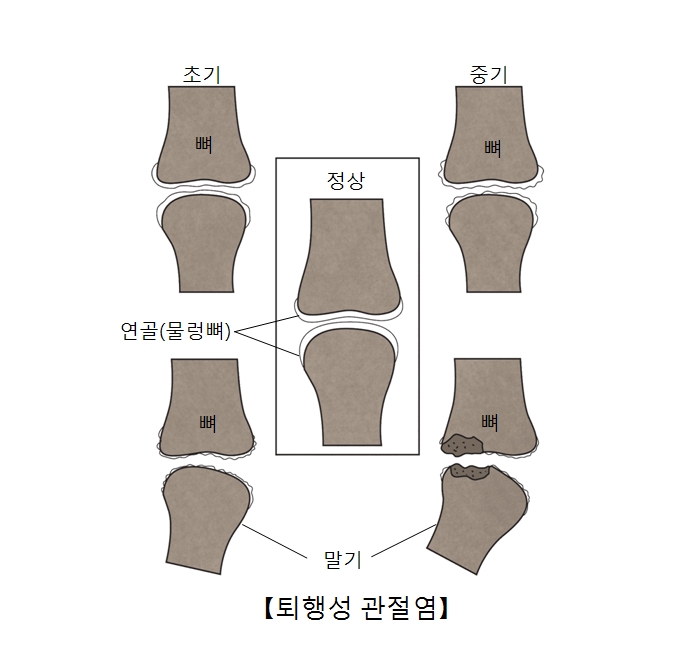 정상인 연골과 퇴행성 관절염의 초기,중기,말기 사진 예시