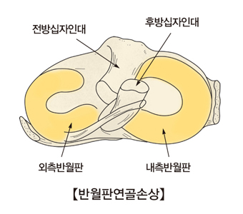 반월판연골이손상된 반달연골과 전방십자인대,후방십자인대,외측반월판,내측반월판위치