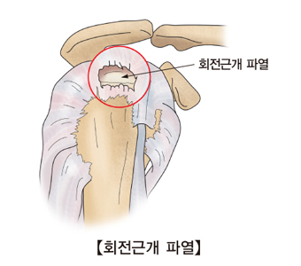 회전근개 파열 사진 예시