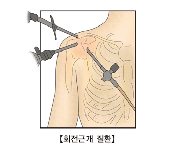 회전근개 질환 사진 예시