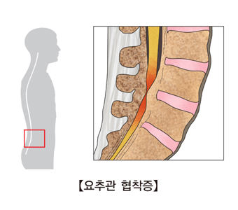 요추관 협착증 사진 예시