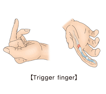 잘펴지지 않는 손가락과 골격도