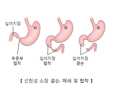 위 주변 십이지장 유문부협착 십이지장협착 십이지장 결손등 선천성 소장 결손,폐쇄 및 협착의 예시