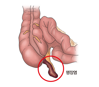 맹장염의 예시