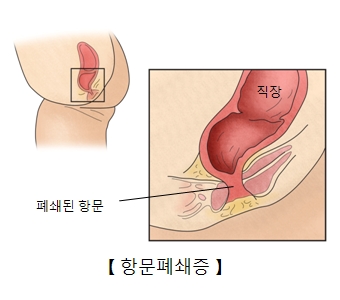 직장의 위치및 폐쇄된 항문등 항문폐쇄증의 예시