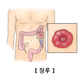 대장안 특정부위에 장루가 위치하고 있는 모습의 예시