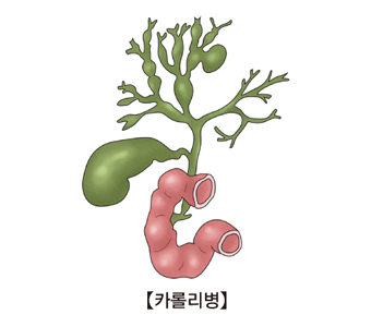 카롤리병의 예시