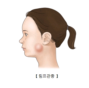 여성 턱선에 림프관종이 생긴 예시