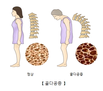 정상여성과척추그림예시및 조직세포 사진예시(오른쪽), 노인여성의 척추그림예시및 조직세포 사진예시(왼쪽)