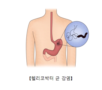 헬리코박터 균 감염의 예시