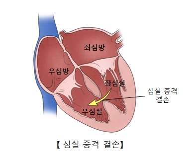 좌심방 우심방 좌심실 우심실의 위치및 심실중격결손의 예시