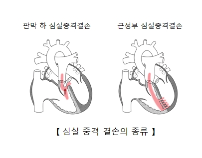 판막 하 심실중격결손과 근성부 심실중격결손등 심실중격 결손의 종류 예시