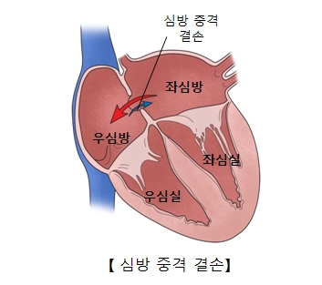 좌심방 우심방 좌심실 우심실 위치및 심방중격결손의 예시