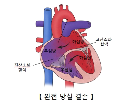 좌심방 우심방 좌심실 우심실의 위치및 저산소화 혈액및 고산소화혈액등으로 인한 완전방실결손의 예시