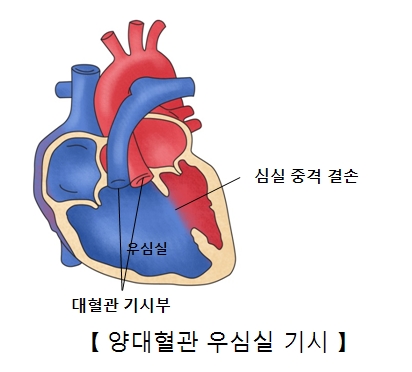 우심실 심실중격결손 대혈관 기시부 위치등 양대혈관 우심실 기시의 예시