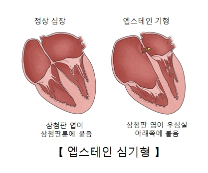 정상심장은 삼첨판 엽이 삼첨판륜에 붙음 엡스테인기형은 삼천판 엽이 우심실 아래쪽에 붙음