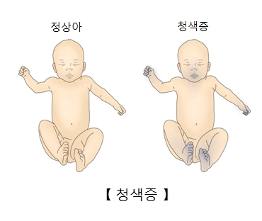 
정상아 와 청색증을 가진 유아의 차이점 예시