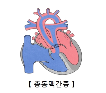 총동맥간증의 예시