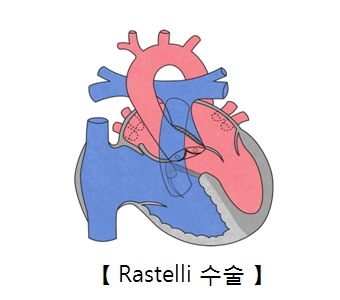 Rastelli 수술의 예시