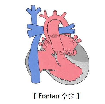 Fontan 수술의 예시