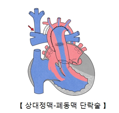 상대정맥 폐동맥 단락술의 예시
