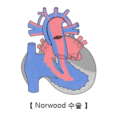 Norwood 수술의 예시