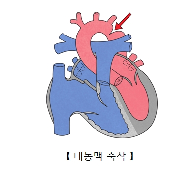 대동맥 축착의 예시