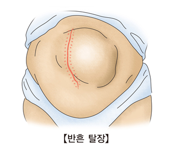 반흔 탈장의 예시