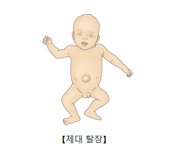 제대 탈장에 걸린 유아