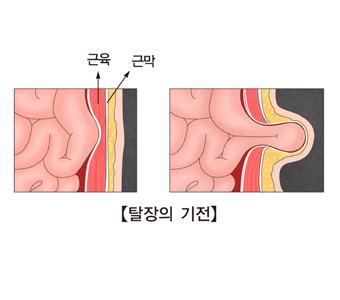 근육및 근막의 위치 및 탈장의 기전의 예시