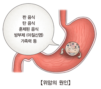 짠 음식 탄 음식 훈제된 음식 방부제(아질산염) 가족력 등 위암의 원인 예시