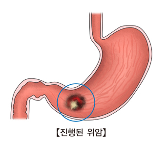 위 안쪽 진행된 위암의 예시