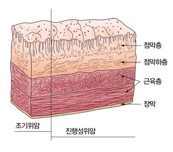 점막층 점막하층 근육층 장막등으로 이루워진 위의 구조와 조기위암 및 진행성위암의 예시