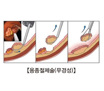 용종절제술(무경성)의 예시