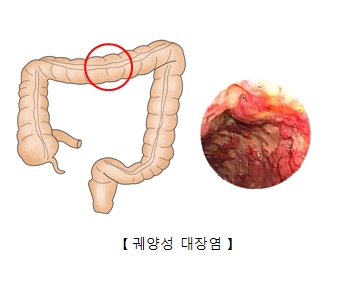 궤양성 대장염의 예시및 실제 사진