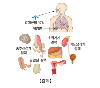 결핵균의 유입 폐병변 중추신경계 결핵 소화기계 결핵 골관절 결핵 비뇨생식계 결핵의 예시