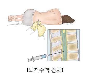 새우자세로누은사람에게 척수액을뽑고있음