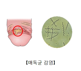 매독균에감염된 남성의성기와 매독균