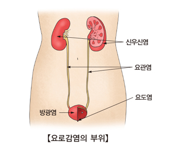 신우신염 요관염 요도염 방광염등 요로감염의 부위 예시