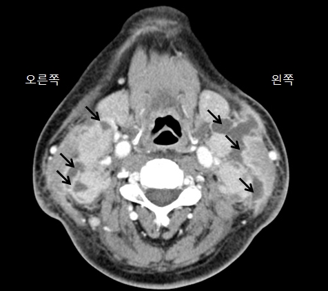 결핵성임파선염의X-ray사진